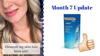 Differin Gel  Month 7 [upl. by Nileuqay742]