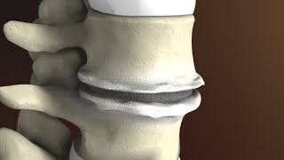 Degenerative Disc Disease Spondylosis explained by Spine Surgeon Dr Jessica Shellock Plano TX [upl. by Devondra775]