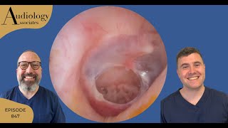 PERFORATED EARDRUM amp TOUGH DRY DEEP EAR WAX REMOVAL  EP847 [upl. by Gnaw]