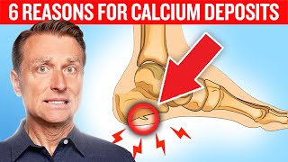 6 Reasons for Calcium Deposits Spurs Osteophytes Stones and Tartar [upl. by Khalsa]