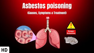 Asbestos Poisoning Causes Symptoms and Treatment [upl. by Nebe]