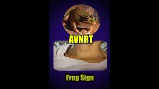 Frog Sign AVNRT [upl. by Trever224]