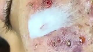 LARGE whitehead Extraction from Cheeks so good  Best Pimple Popping Videos [upl. by Meelas]