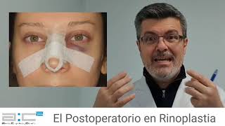 El Postoperatorio en Rinoplastia [upl. by Hurlbut]