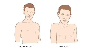 CAUSES OF PROTRUDING CHEST SUNKEN CHEST IN TCM [upl. by Iramat]