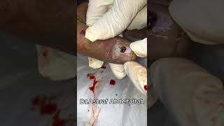 subungual hematoma تجمع دموي تحت الاصبع [upl. by Pfister]