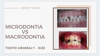 DEVELOPMENTAL DISTURBANCES OF TEETH  PART 1SIZE [upl. by Huntington889]