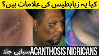 Acanthosis Nigricans Causes  Symptoms Treatment [upl. by Trabue222]