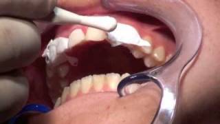 veneers  nonprep [upl. by Oaoj]