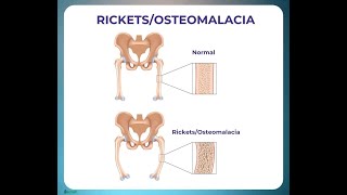 What is the Vitamin Deficiency in Osteomalacia Vitamin D Deficiency [upl. by Lacie]