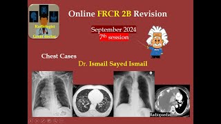 FRCR 2b Session 7 September 2024 Chest [upl. by Ereveniug]