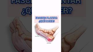 FASCITIS PLANTAR ¿QUÉ HACER [upl. by Knowle]