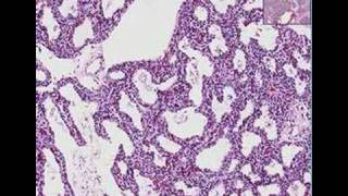 Histopathology Lung Interstitial pneumonia [upl. by Aldo]