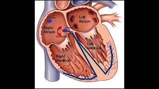 Atrioventricular Nodal Reentrant Tachycardia AVNRT Disease healthcare health disorder [upl. by Arenat]