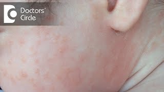 What are the causes of Rashes  Dr Rashmi Ravindra [upl. by Annoyi]