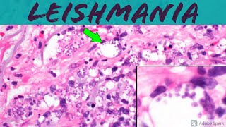 Leishmaniasis Leishmania Infection 5Minute Pathology Pearls ‪Dermatology Dermatopathology [upl. by Ah767]