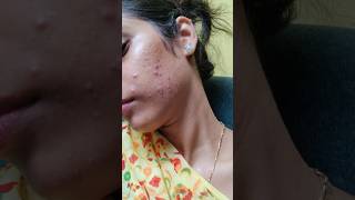 Charusheela ki pimples  Oily skin Acne prone skin tips  telugu girl skin care  Telugu mini vlogs [upl. by Hulburt854]