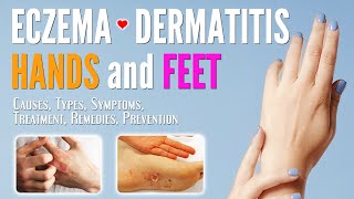 Eczema on Hands and Feet Causes Symptoms Types Treatment Remedies Prevention  Dermatitis treat [upl. by Perla]