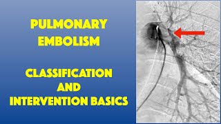 PE Classification amp Intervention Basics [upl. by Otrebilif676]