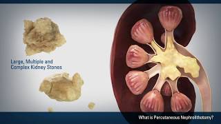 Lithotripsy Device Shatters Peppermint  Ed Bowles  Valdese Hospital [upl. by Fulks]