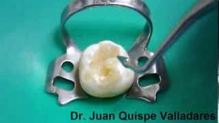 Curación Dental con resina Parte 1  PermaSeal Ultradent [upl. by Longerich552]