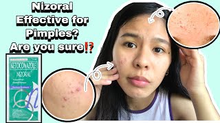 How To Clear Fungal Acne  My Fungal Acne Clearing Routine [upl. by Valerle]