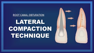 Lateral compaction technique  Root canal Obturation [upl. by Ogram358]