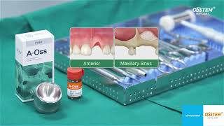 AOSS Osstem Implant bovine xenograft luudutusmateriaali [upl. by Idieh]