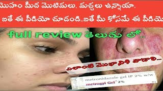 Metrogyl gel use amp review in teluguhow to use pimples best cream for acnes and pimple [upl. by Warrick]