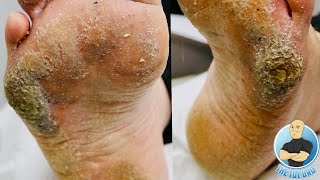 EXTRA THICK HARD SKIN REMOVAL TREATMENT CRAZY BIG CALLUS [upl. by Renelle]