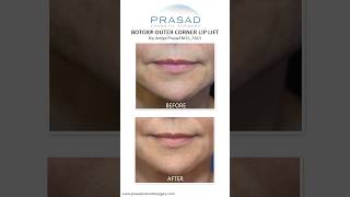 How the Botox Lip Lift Works smile [upl. by Nerrad441]