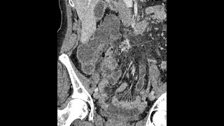 Appendicitis  perforated  complicated  appendicoliths present [upl. by Edahs]