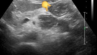 Diagnostic dilemma Pancreatic Lesion Jejunal Loop Mimicking Cancer on Ultrasound – CT Clarifies [upl. by Clayson]