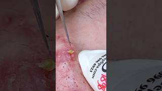 P001  SacDepSpa acne pimple sacdepspa blackheads [upl. by Demeyer]