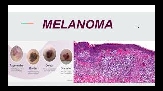 Malignant Melanoma Pathogenesis Morphology and Clinical picture [upl. by Lenoyl143]