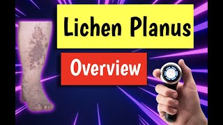 Lichen planus causes treatment diagnosis management [upl. by Idisahc]