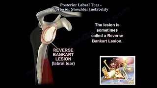 Posterior Labral Tear Shoulder Instability  Everything You Need To Know  Dr Nabil Ebraheim [upl. by Ashely989]