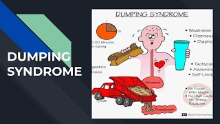 DUMPING SYNDROME [upl. by Wilfrid]