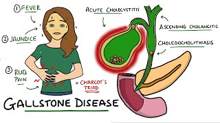 Gallstone Disease  Acute Cholecystitis vs Cholelithiasis vs Choledocholithiasis vs Cholangitis [upl. by Dyl]