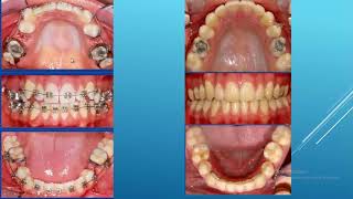 La tecnica de premolares vs tecnica de segundos molares en Ortodoncia [upl. by Tut]