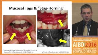 Extraintestinal Manifestations in Pediatric IBD Orofacial granulomatosis [upl. by Avivah613]