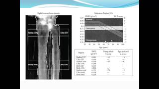 Bariatric Osteomalacia Fiona Cook MD  Internal Medicine Grand Rounds [upl. by Sina]