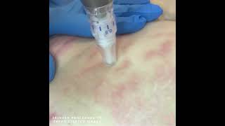 Skinpen Microneedling Procedure To Treat Stretch Marks [upl. by Moselle]