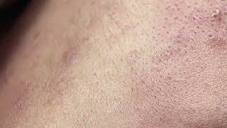 Acne on skin  Remove nose pimples  Acne Treatments Mai Ngoc 💕💕💕 [upl. by Ettenoj446]