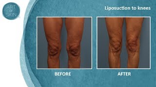 Lipo of knees [upl. by Rosalyn]