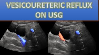 VESICOURETERIC REFLUX VUR ON ULTRASOUND  USE OF COLOR DOPPLER [upl. by Anolla]