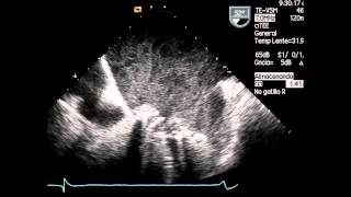 TEE  TROMBOSIS PROTESIS MITRAL [upl. by Winter797]