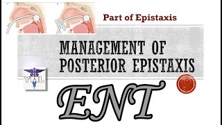 Management of Posterior Epistaxis — Part of Epistaxis [upl. by Alracal871]