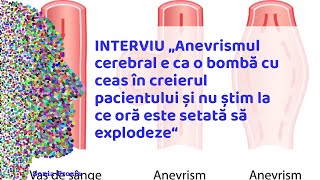 Un anevrism cerebral e ca o bombă cu ceas Explicațiile neurochirurgului Asset 3 Asset 3 Asset 3 [upl. by Kurtzman]