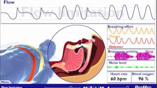 Understanding Sleep Disordered Breathing [upl. by Finbar]